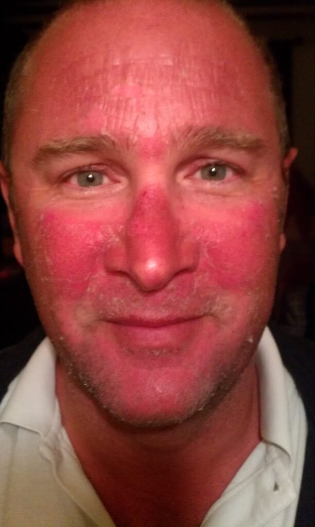 very bad sunburn