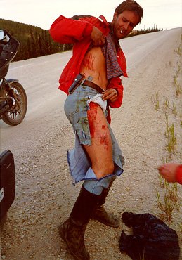 skin damage after very fast motorcycle crash