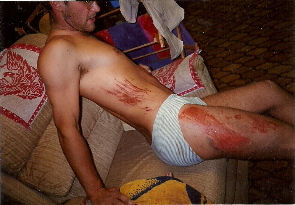 skin damage after bike accident